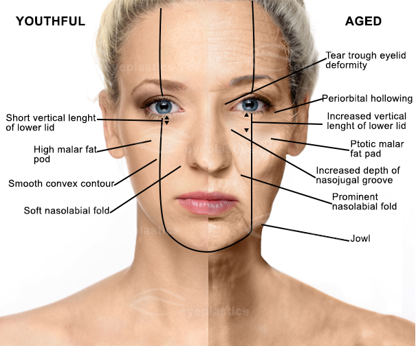 mid face aging face | Face lift | Facelift